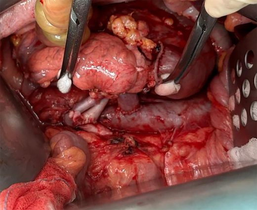Trapianto di pancreas