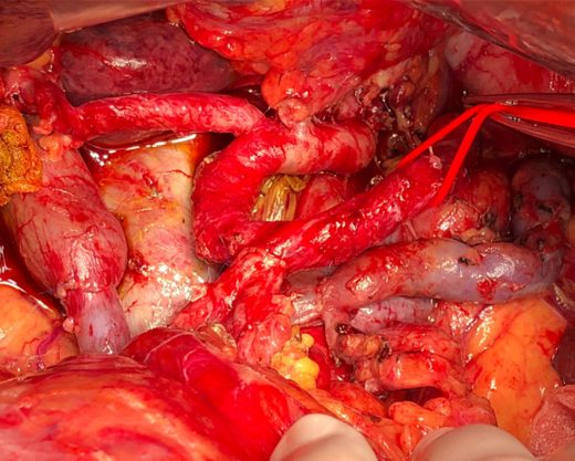 Asportazione di cancro della testa del pancreas (pancreasectomia totale) con infiltrazione dell'arteria e della vena mesenterica superiore dopo chemioterapia