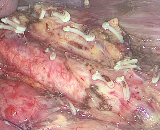 Nefrectomia e linfadenectomia paraortica per tumore maligno del rene