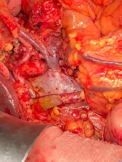 Asportazione di cancro della testa del pancreas con infiltrazione della vena mesenterica