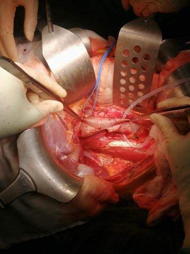 Nefrectomia sinistra, con asportazione di trombo neoplastico nella vena cava inferiore, per cancro del rene