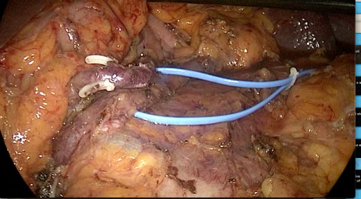 Pancreasectomia sinistra con conservazione della milza e dei vasi splenici per tumore neuroendocrino