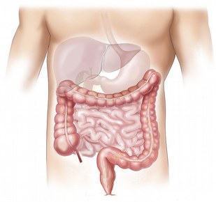 Cancro del colon e del retto